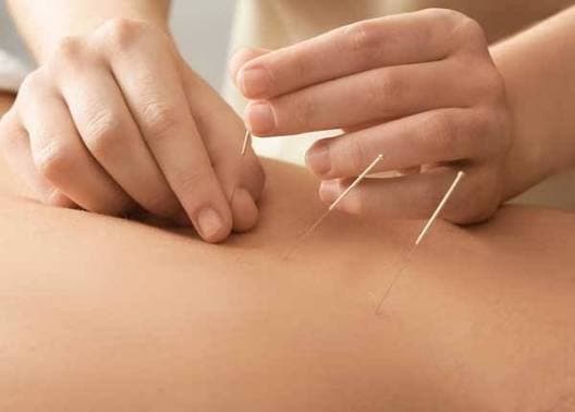 Close-up of an Aero Performance physical therapist inserting dry needles into a patient’s upper back muscle during a dry needling session in the Coralville, Iowa clinic